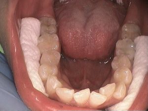 hyperdontia real